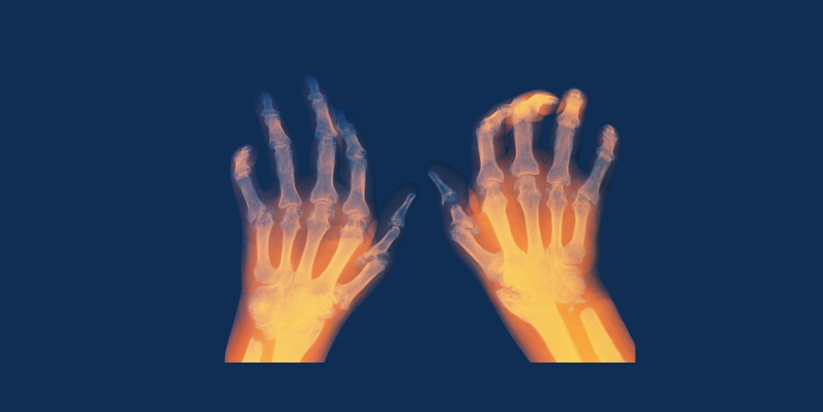 Untitled design Rheumatoid Arthritis After Hysterectomy