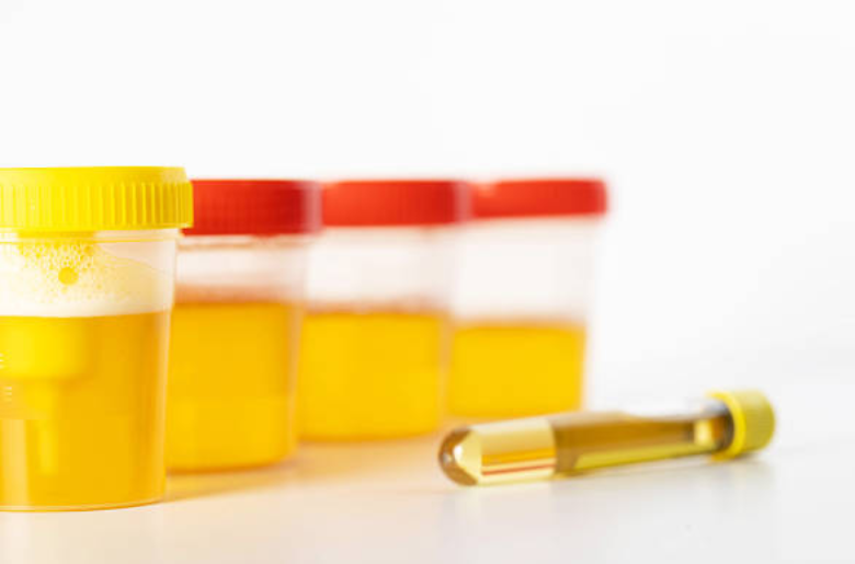 Recurrent urine infections in children Hyderabad